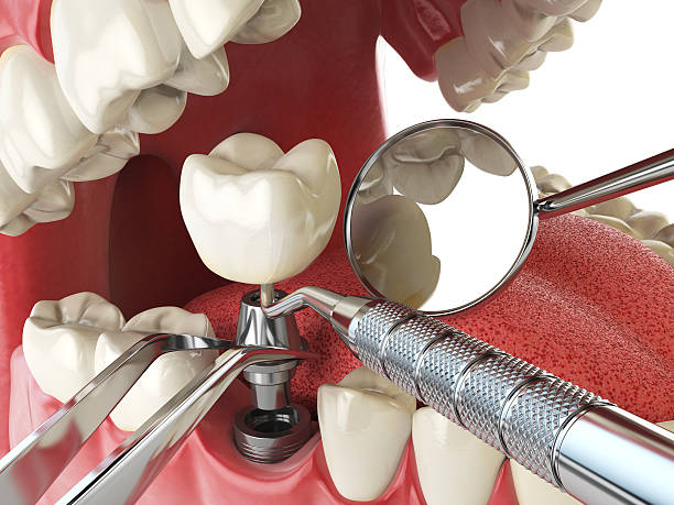 Best Urgent Care for Lost Fillings or Crowns in Mount Hore, WI